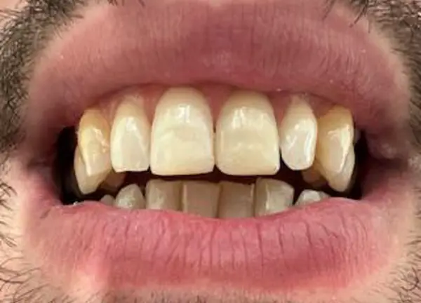 Reconstrucción de incisivos fracturados - Doctora Minerva