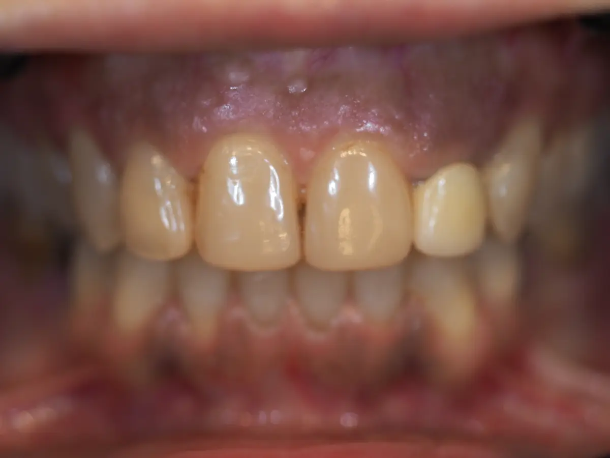 Estética dental y carillas - Clínica Doctora Minerva