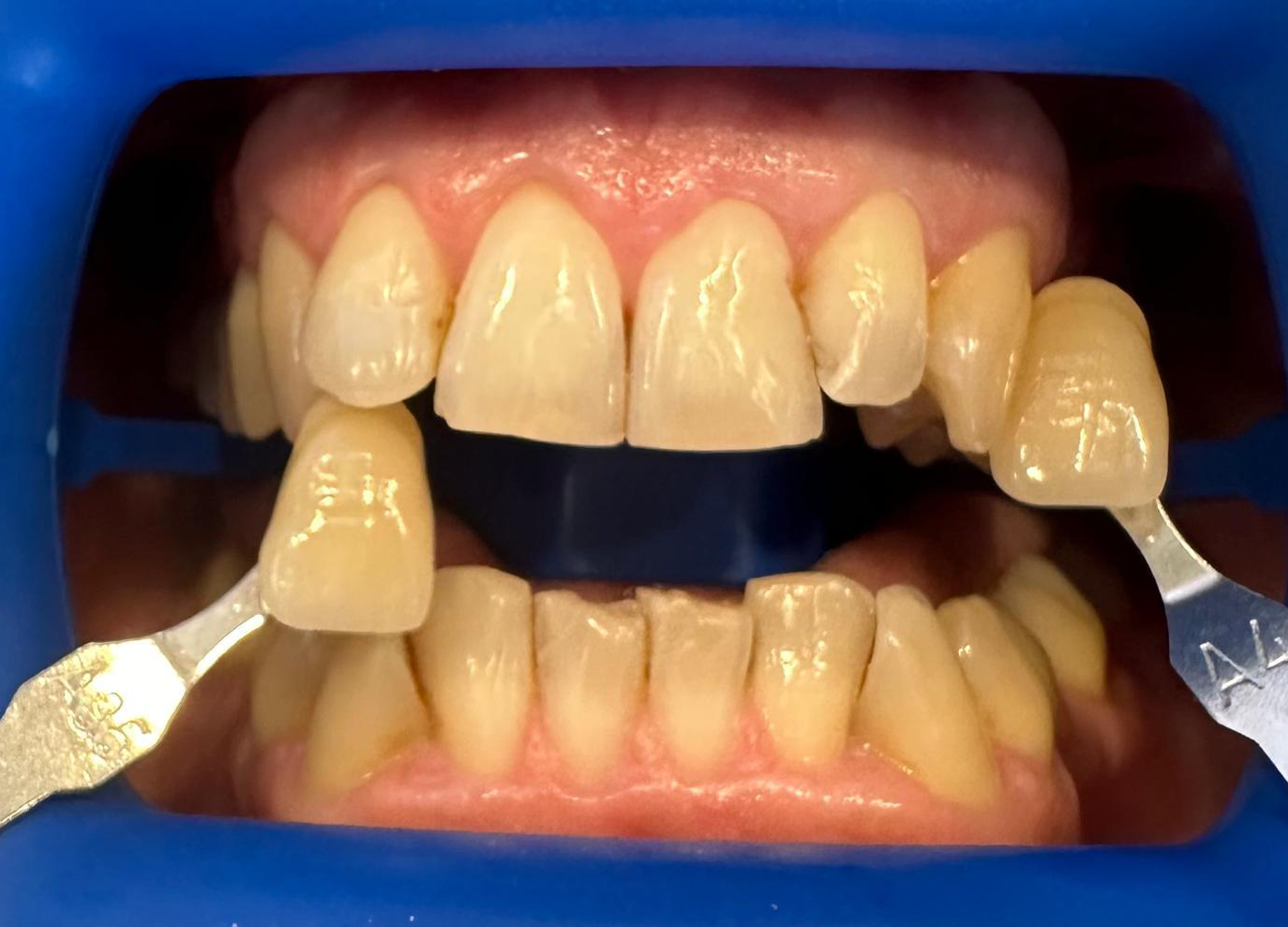Blanqueamiento dental antes