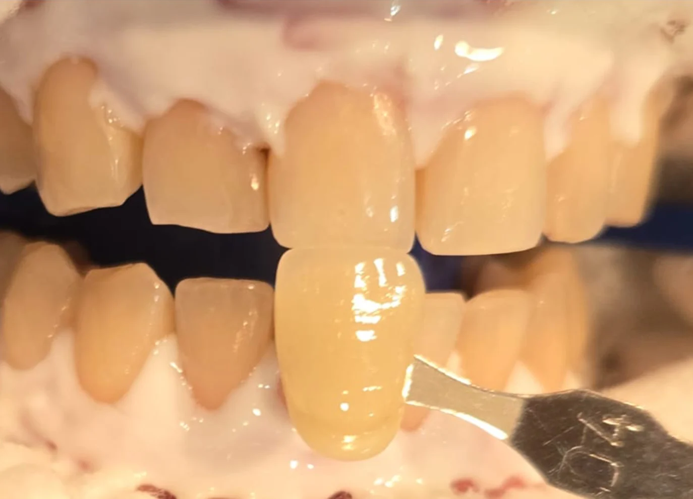 Blanqueamiento dental con resultado B1