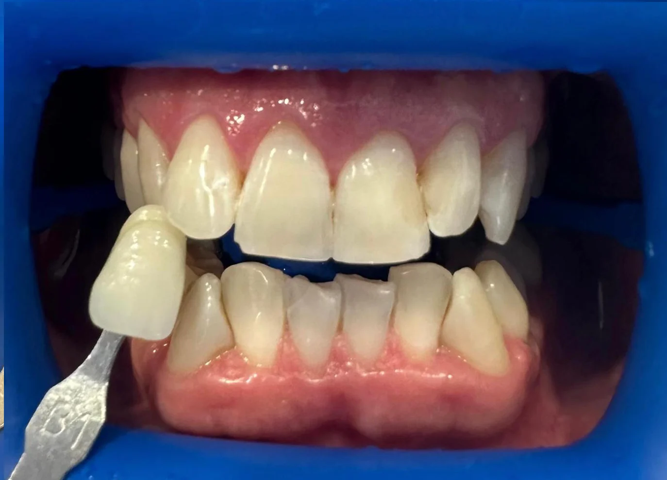Blanqueamiento dental después