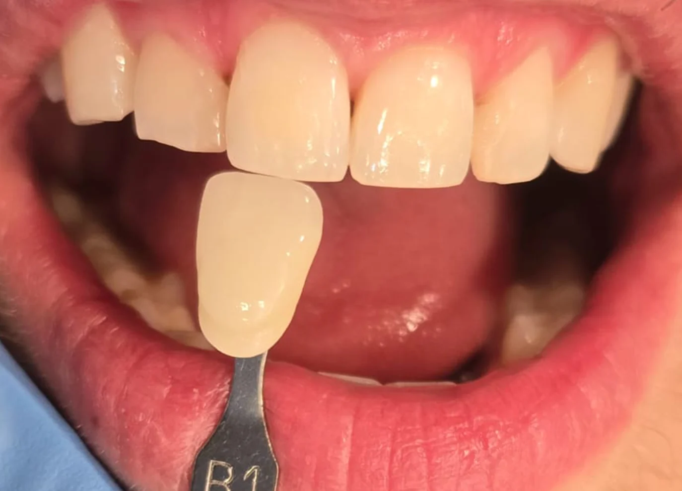 Blanqueamiento dental con resultado B1