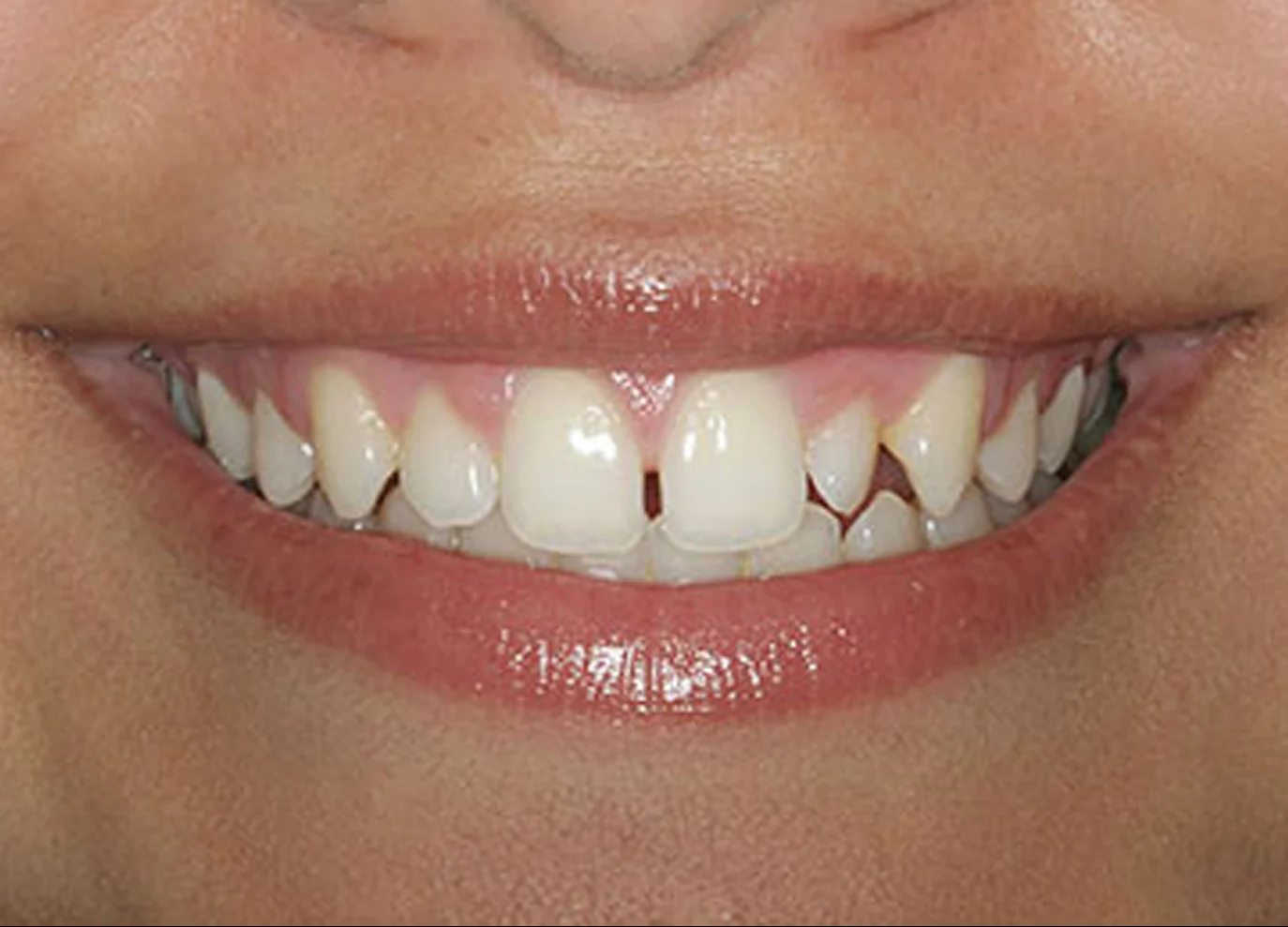 Carillas dentales ultrafinas