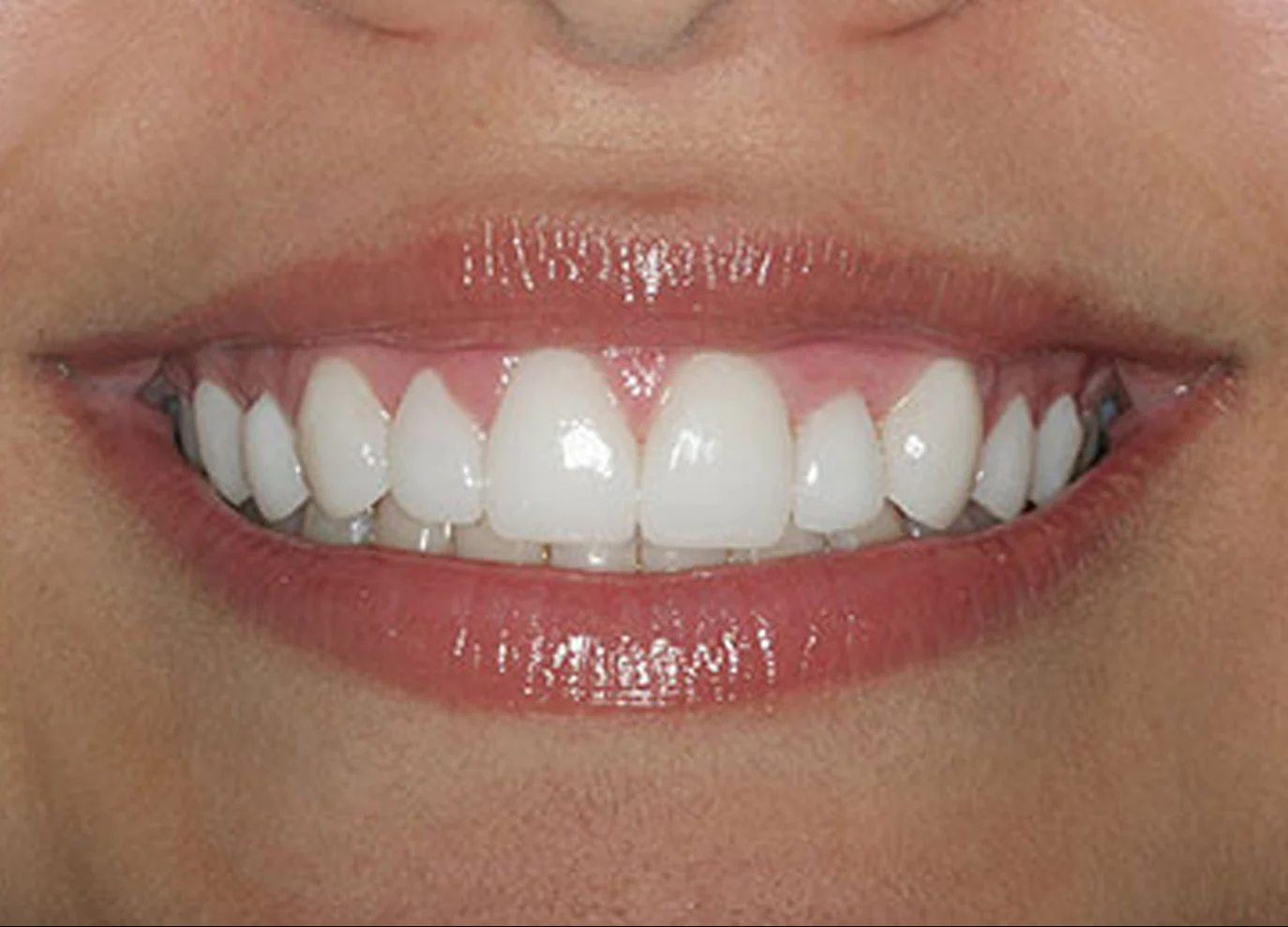 Carillas dentales ultrafinas