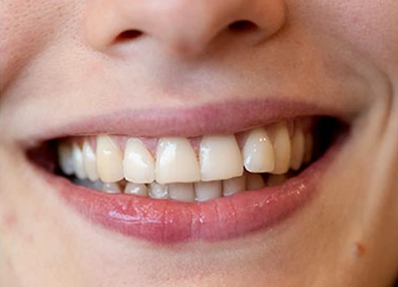Carillas dentales en Montcada i Reixac