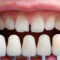 ¿En qué consiste un implante dental?