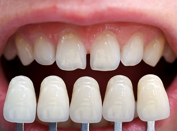 Carillas y estética dental