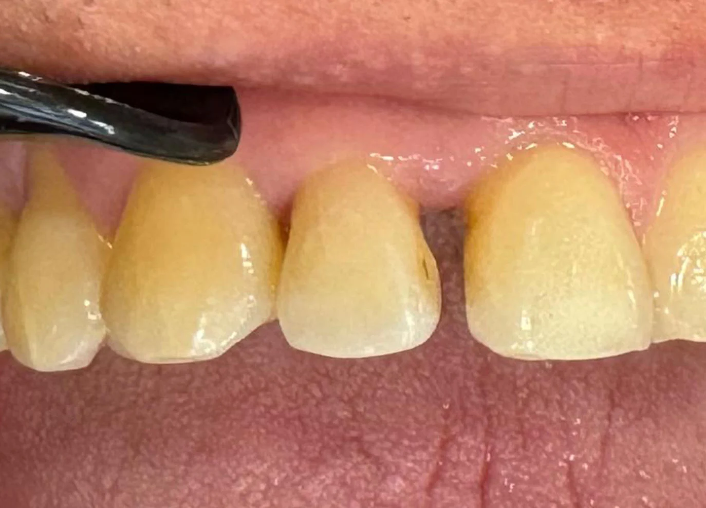 Cierre de diastema