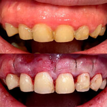 Conseqüencies malalties periodontals