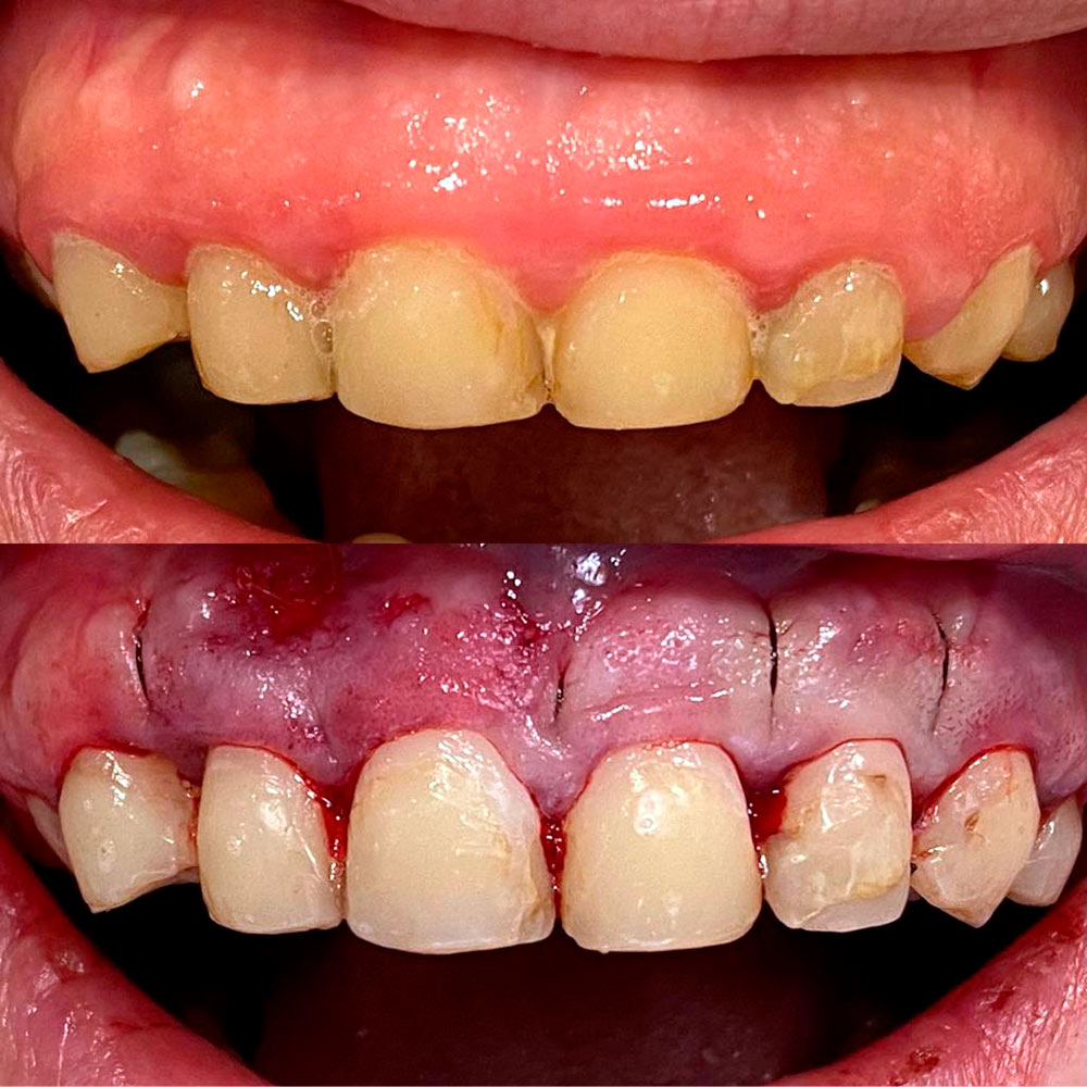 Consecuencias enfermedades periodontales
