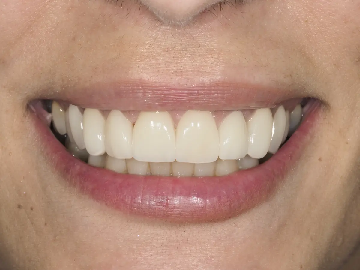 Estética dental y carillas - Clínica Doctora Minerva