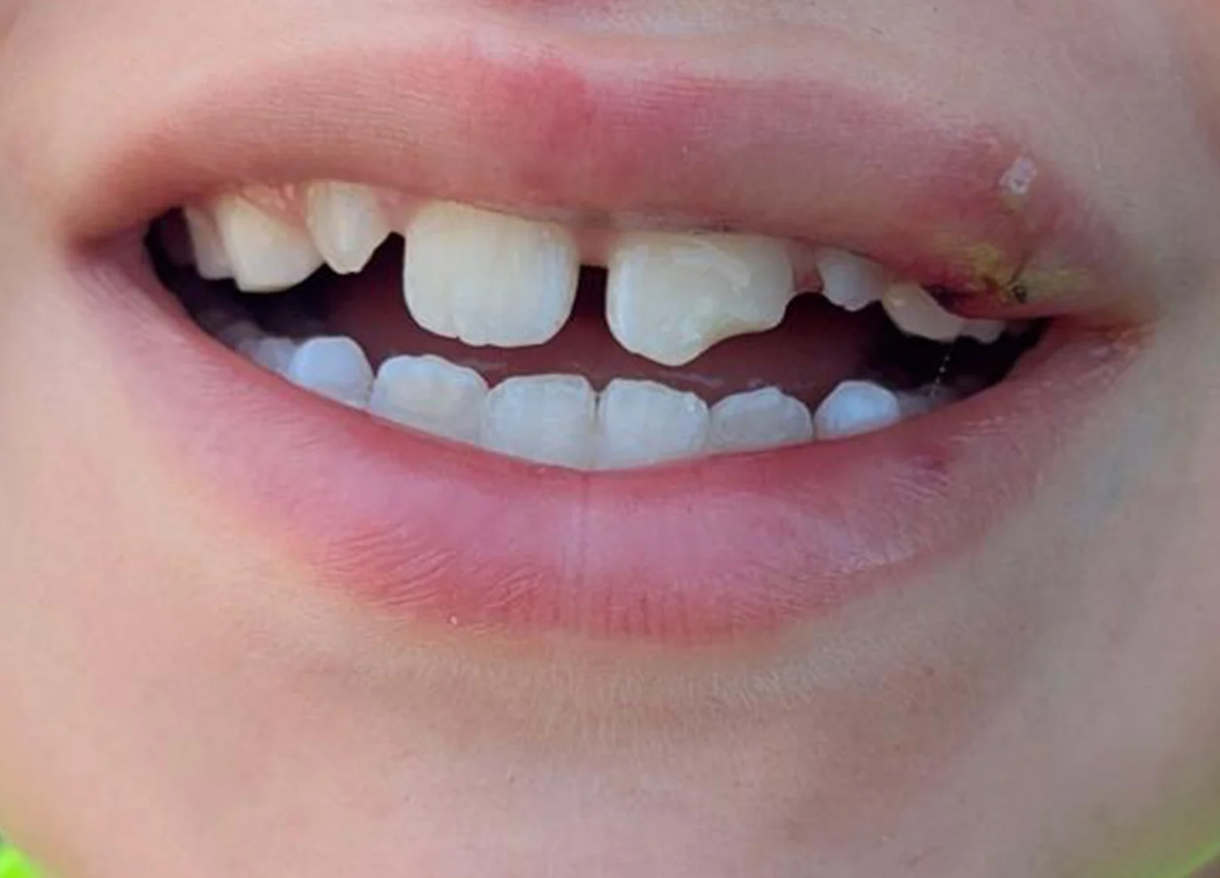 Reconstrucción dental tras traumatismo