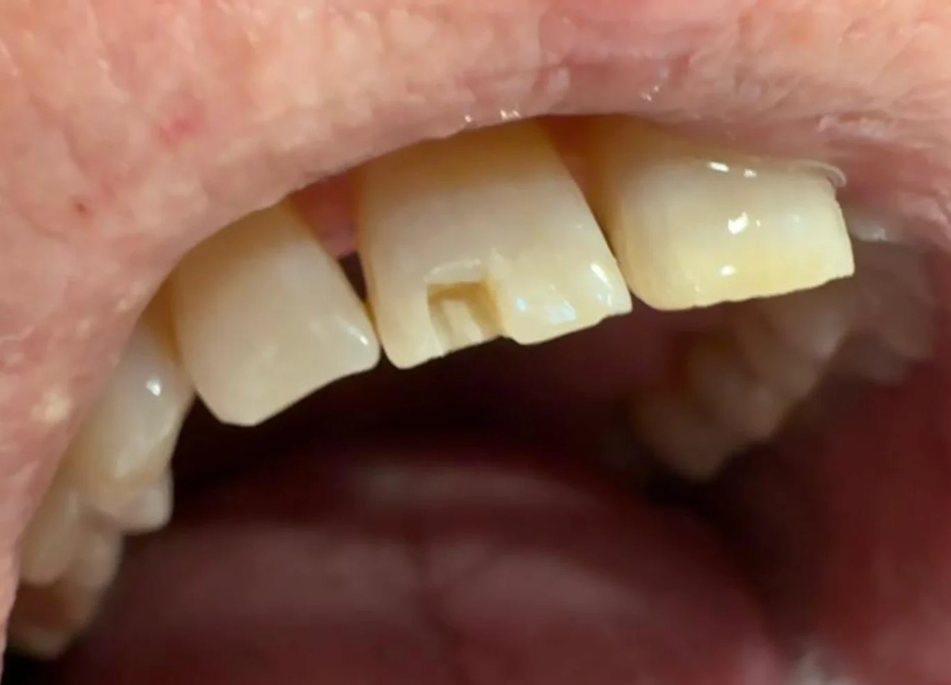 Reconstrucción dental con composite