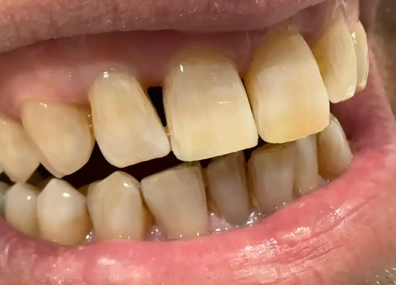 Reconstrucción dental con composite