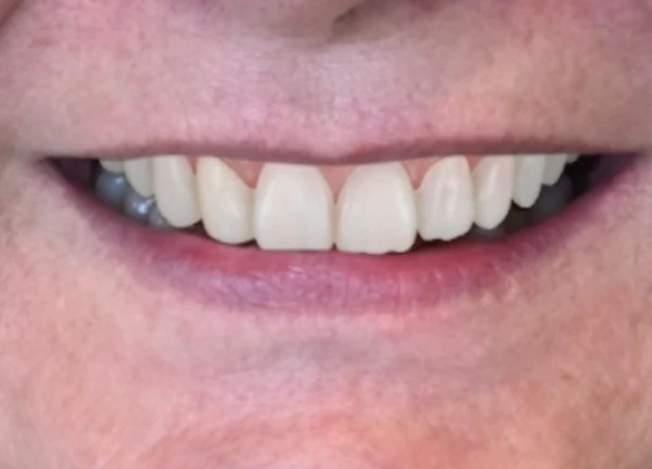 Diseño digital de sonrisa después