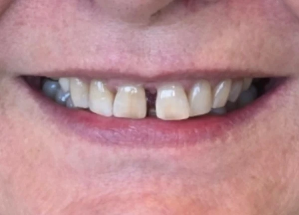 Diseño digital de sonrisa antes