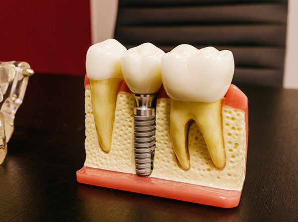 ¿En qué consiste un implante dental?