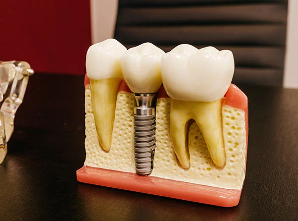 Implante dental