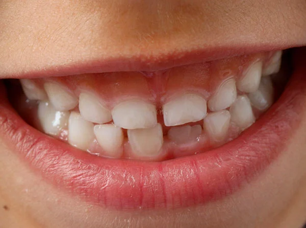 Malposiciones dentales Malposiciones dentales