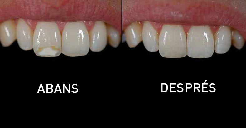 estetica dental composite