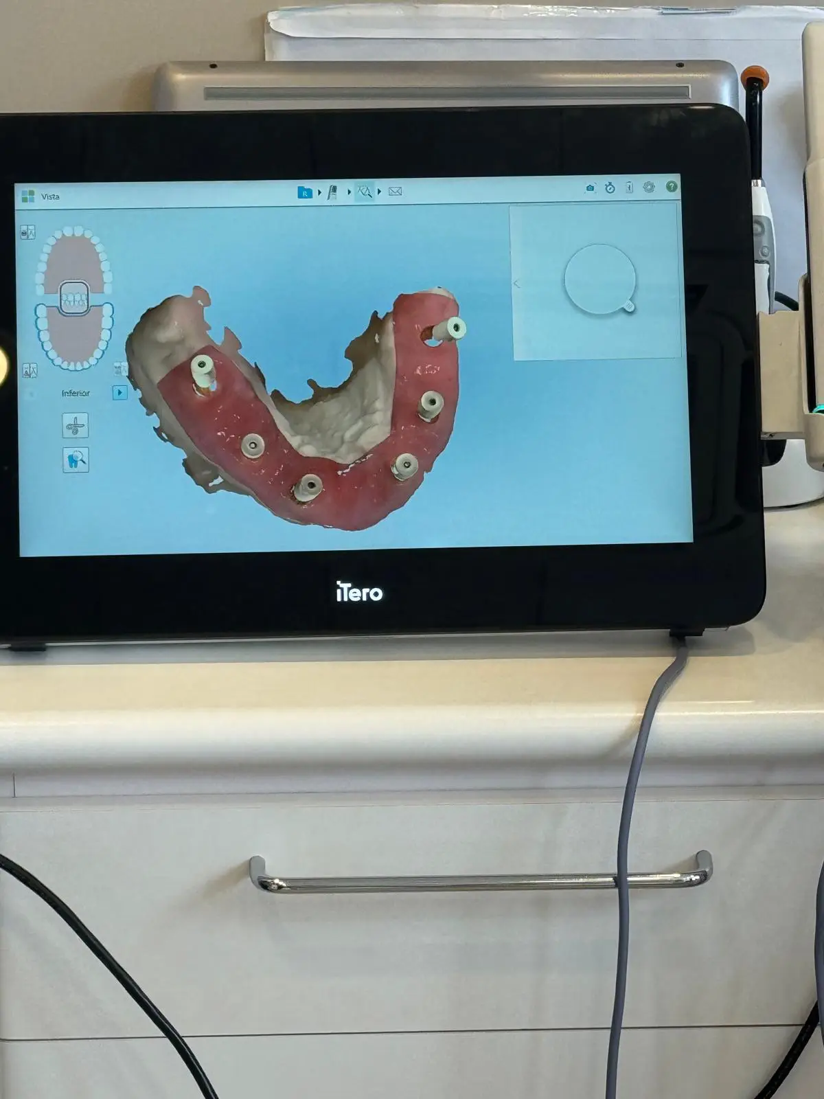 Implantología y prótesis dentales – Clínica Doctora Minerva Implantología y prótesis dentales - Clínica Doctora Minerva