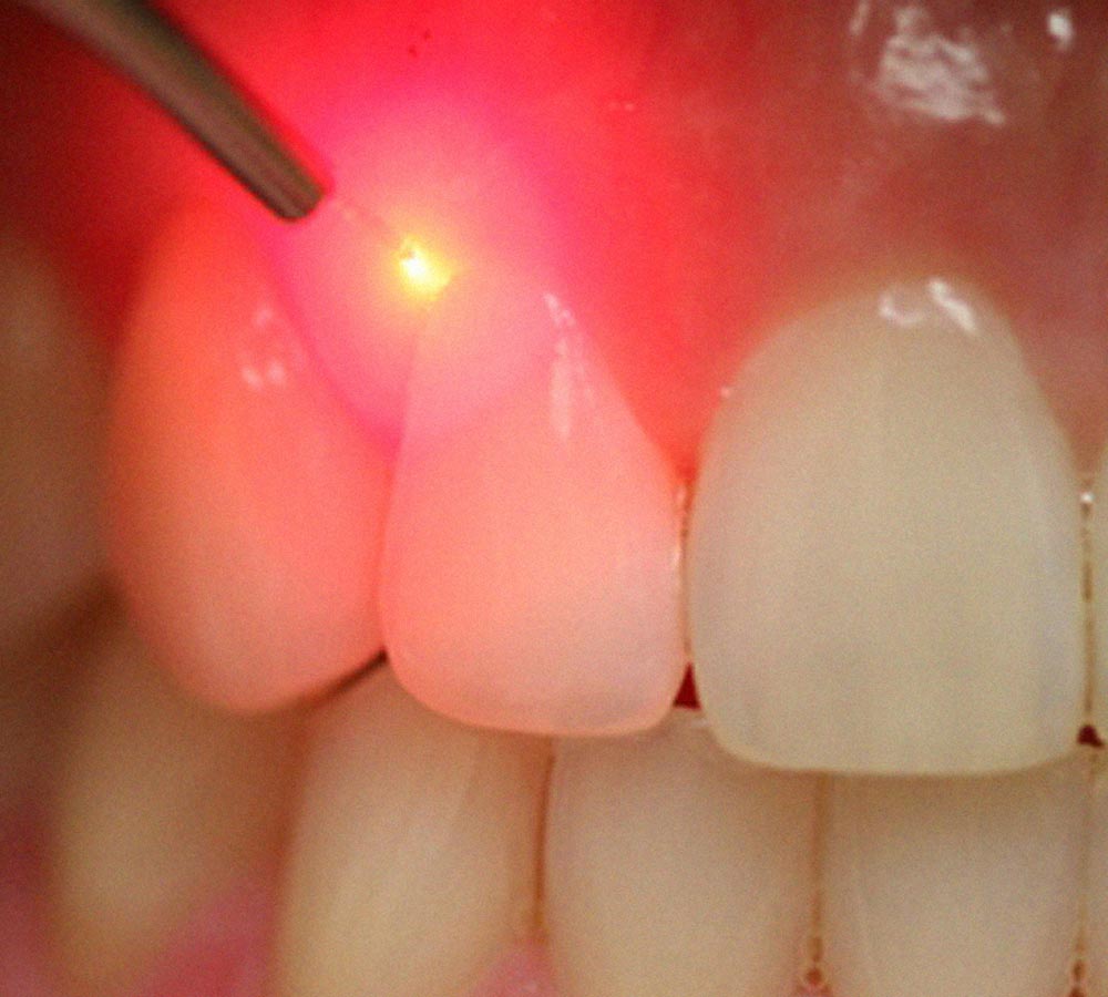 laser odontologico