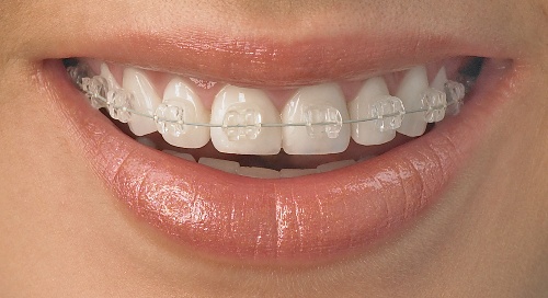 ortodoncia aparatos dentales