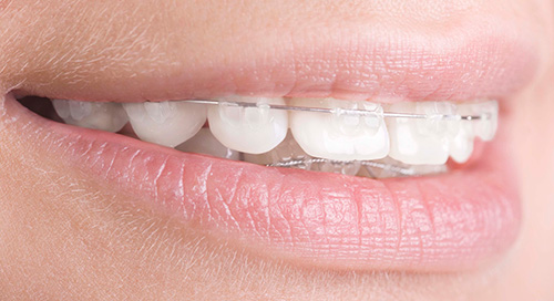 ortodoncia aparatos dentales