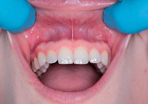 Preguntas y respuestas sobre el tratamiento de endodoncia