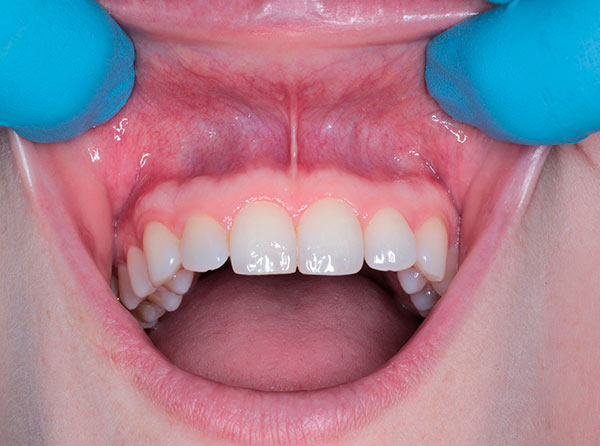 Preguntas y respuestas sobre el tratamiento de endodoncia