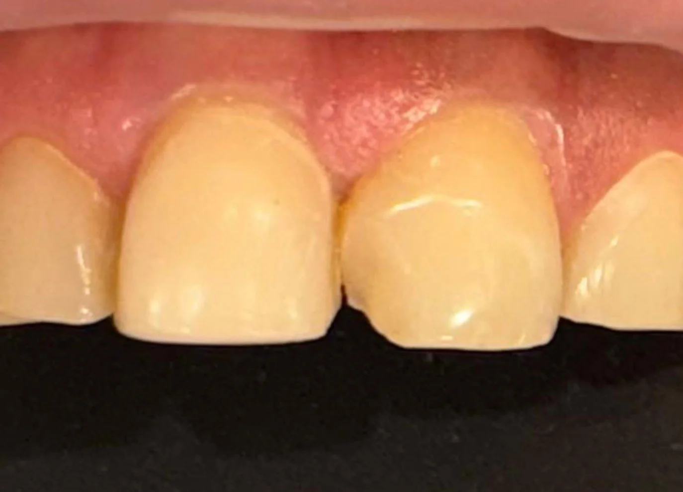 Reconstrucción dental de un diente fracturado
