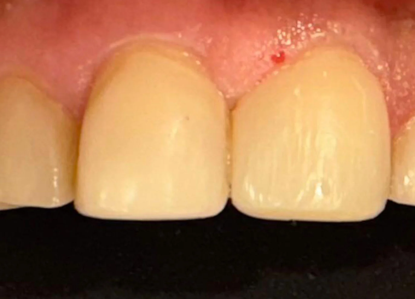Reconstrucción dental de un diente fracturado