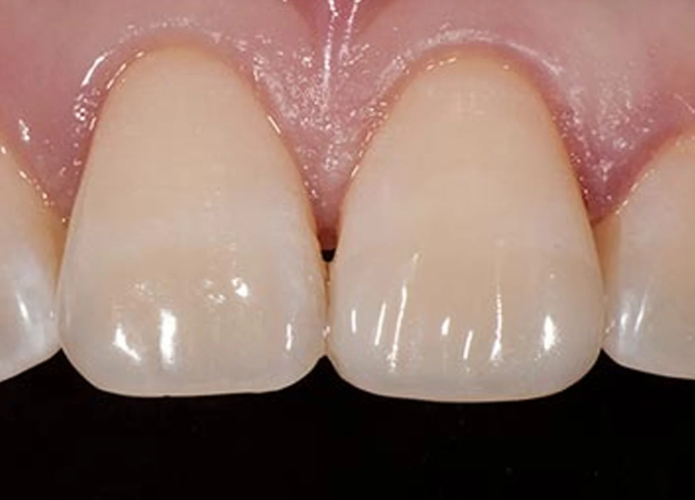 Reconstrucción dental en un incisivo central