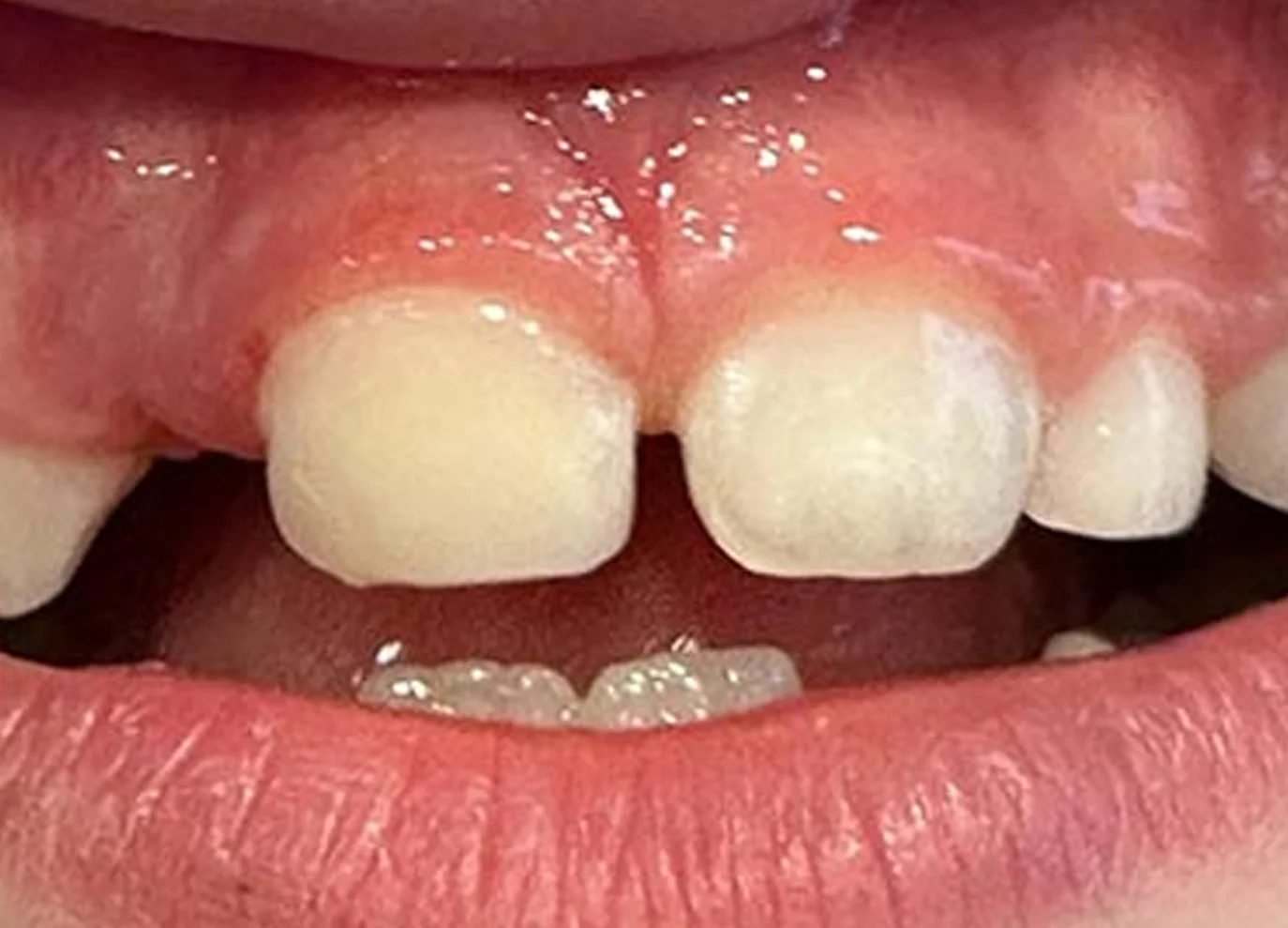 Solución a traumatismo dental