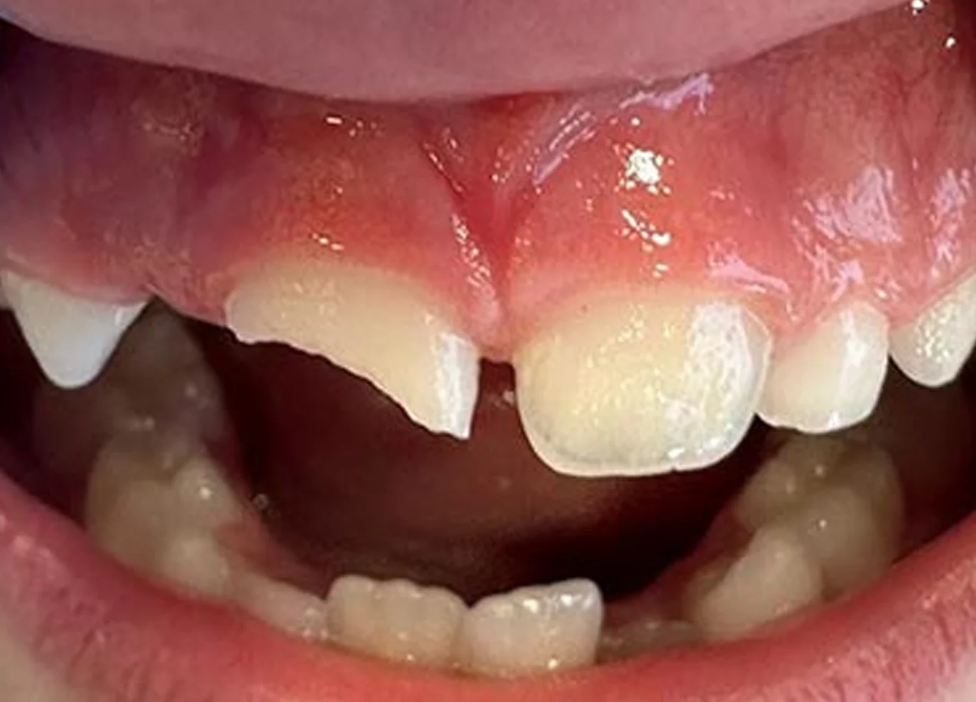 Solución a traumatismo dental